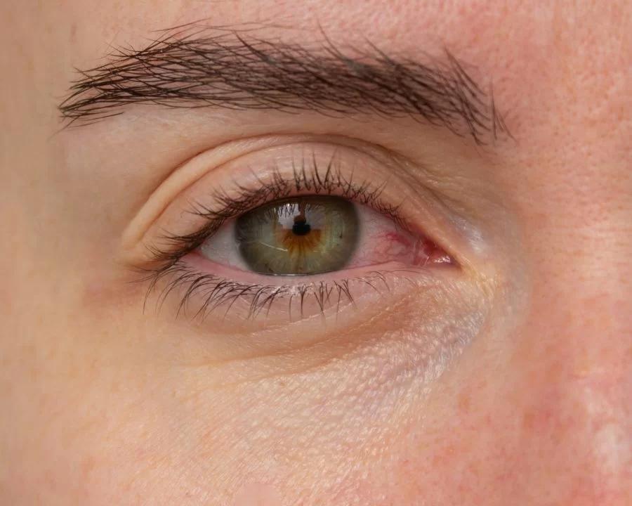 Thuốc nhỏ mắt mát lạnh như V.Rohto Cool, Sante FX Neo có thể gây cay xót, chảy nước mắt, nhức hoặc làm khô rát hơn nếu lạm dụng quá nhiều lần mỗi ngày