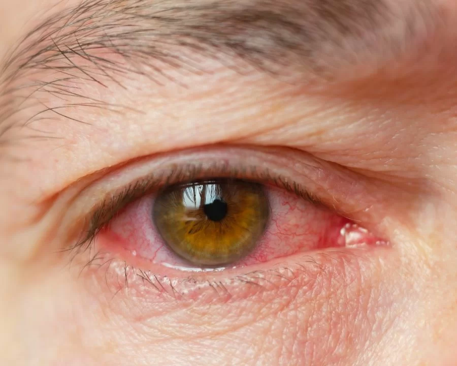 Nước nhỏ mắt chống mỏi bổ sung vitamin (Rohto Vita 40, Eyemiru 40EX, Sancoba) có thể gây ngứa đỏ, mờ tạm thời sau khi nhỏ và kích ứng mạn tính nếu lạm dụng lâu dài.