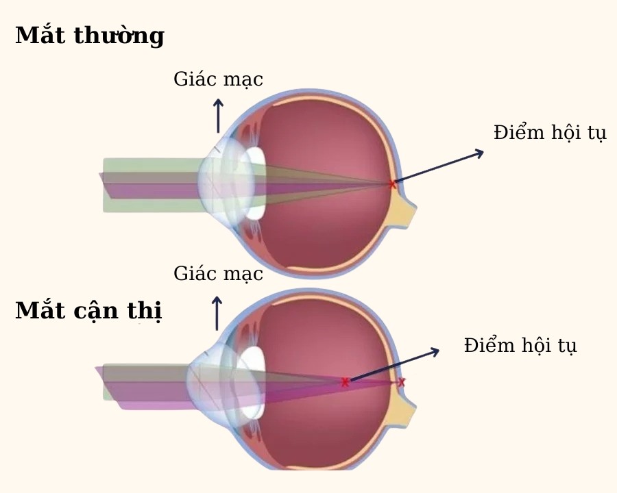 Bị cận thị nặng nhất bao nhiêu độ, có gây mù? Cách kiểm soát (4) Cấu tạo của mắt bị cận nặng thường có giác mạc bất thường