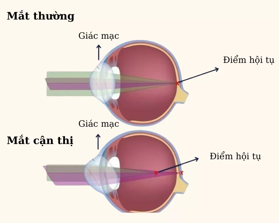 Mức độ cận nhẹ nhất là bao nhiêu độ? Dấu hiệu, cách chăm sóc (2) Ở độ cận nhẹ nhất trục nhãn cầu đã có thay đổi