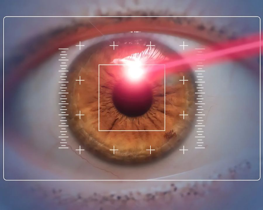 Mắt cận 10 độ có mổ được không? Phương pháp, chỉ định bác sĩ (6) Phẫu thuật FEMTO Pro điều trị tật cận - viễn - loạn thị với độ cận tối đa 10-12 Diop, viễn thị 6 Diop và loạn thị 6 Diop.