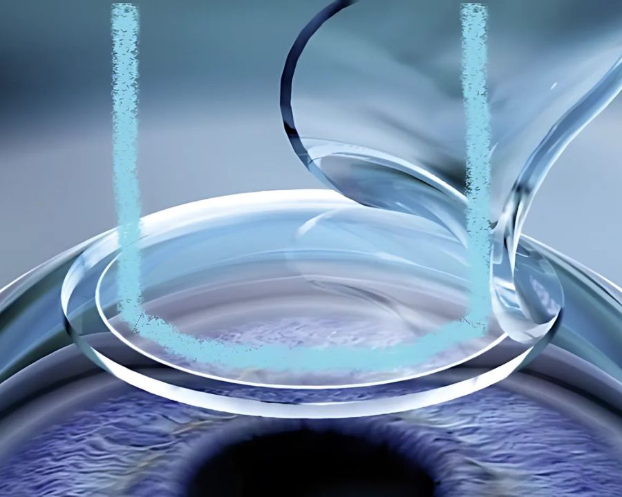 Mắt cận 10 độ có mổ được không? Phương pháp, chỉ định bác sĩ (7) Phẫu thuật FEMTOLASIK có thể áp dụng cho bệnh nhân có độ khúc xạ cao và giác mạc tương đối mỏng.