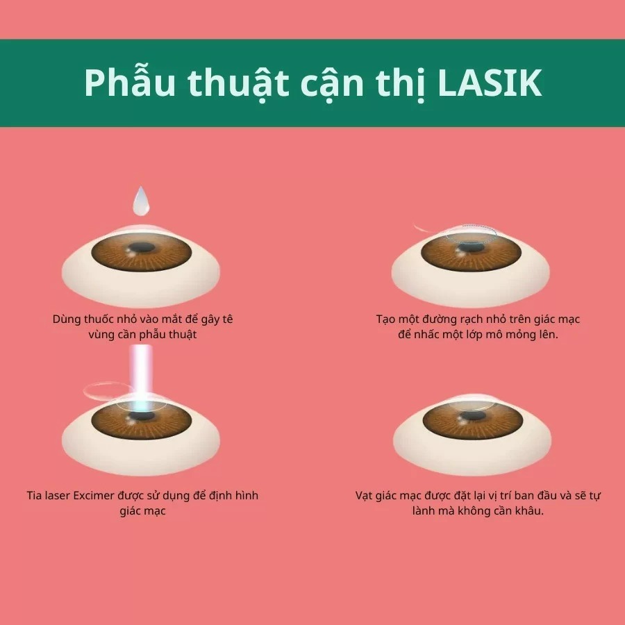 Cận 2 độ có nên mổ mắt không? Điều kiện và lưu ý khi bắn cận (4) Các bước phẫu thuật cận thị Lasik