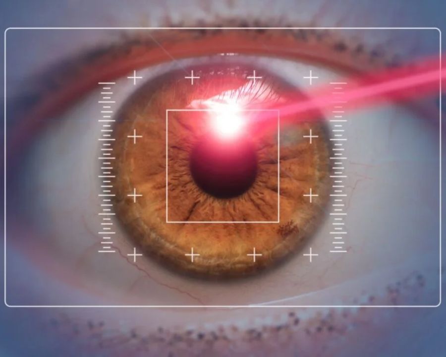 SMILE (ReLEx SMILE) không tạo vạt giác mạc nên giúp giữ vững cấu trúc giác mạc, hạn chế khô mắt, giảm nguy cơ biến chứng. 