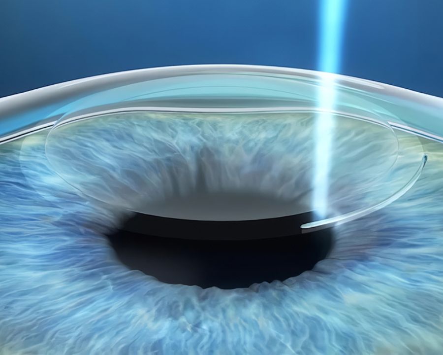 So với LASIK truyền thống, FEMTO Pro giúp quá trình tạo vạt êm ái, ít xâm lấn, an toàn hơn và được FDA (Mỹ) chứng nhận.