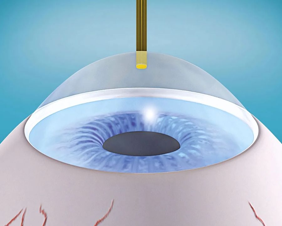 Khác với LASIK hay SMILE, SmartSurface không tạo vạt giác mạc và không có vết mổ cơ học.