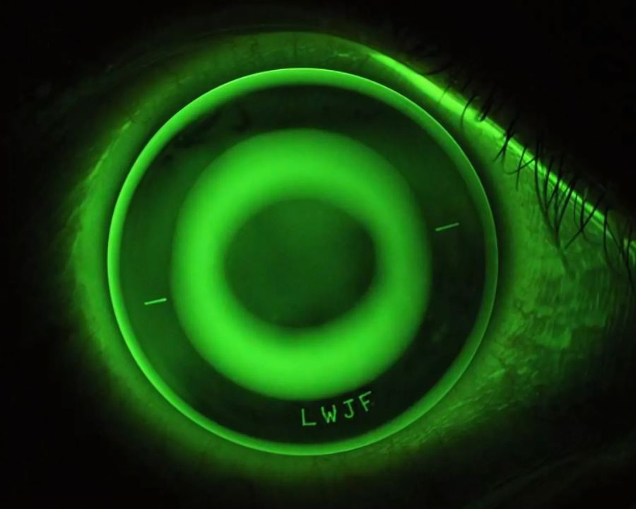 Cận thị ở trẻ em có chữa được không? Tư vấn A-Z cùng chuyên gia (4) Journal of Ophthalmology (2019) khẳng định Ortho-K có thể làm chậm 40–60% tốc độ tiến triển cận thị ở trẻ từ 6–12 tuổi