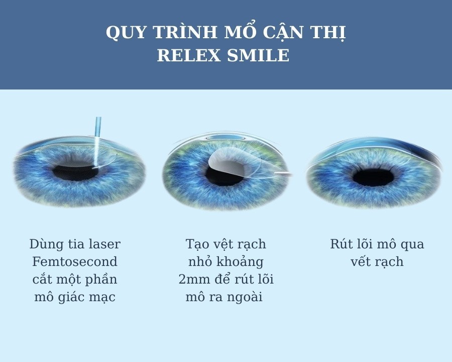Mổ cận Relex Smile: Phương pháp, chi phí, điều kiện xóa cận (5) Quy trình mổ cận Relex