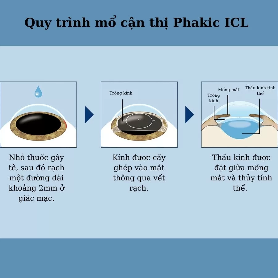 Mổ Phakic ICL là gì, chi phí, an toàn không, có nên chọn? (5) Mô tả 3 bước cơ bản của mổ Phakic