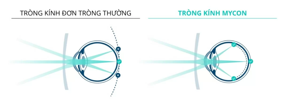 Rodenstock MyCon - Tròng kính kiểm soát tiến triển cận thị cho trẻ em - Chống UV100% (7) So sánh tròng kính MyCon và tròng đơn thông thường