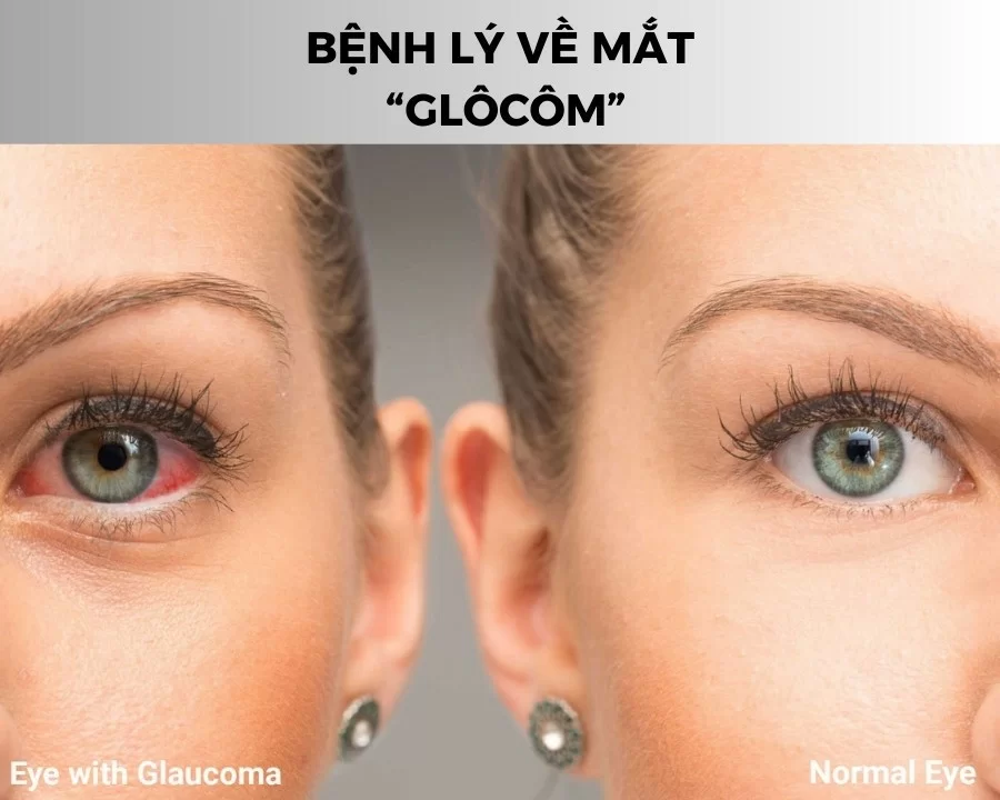 Bệnh Glôcôm là gì? Nguyên nhân, triệu chứng và cách điều trị