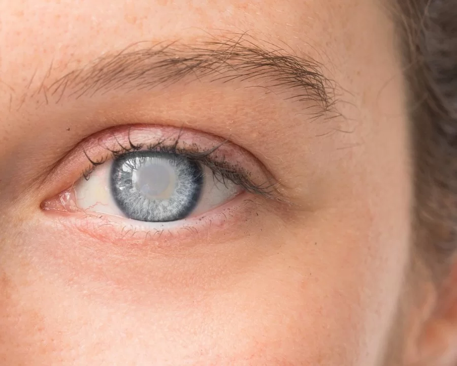 Đục thủy tinh thể là gì? Nguyên nhân bị và phân loại bệnh