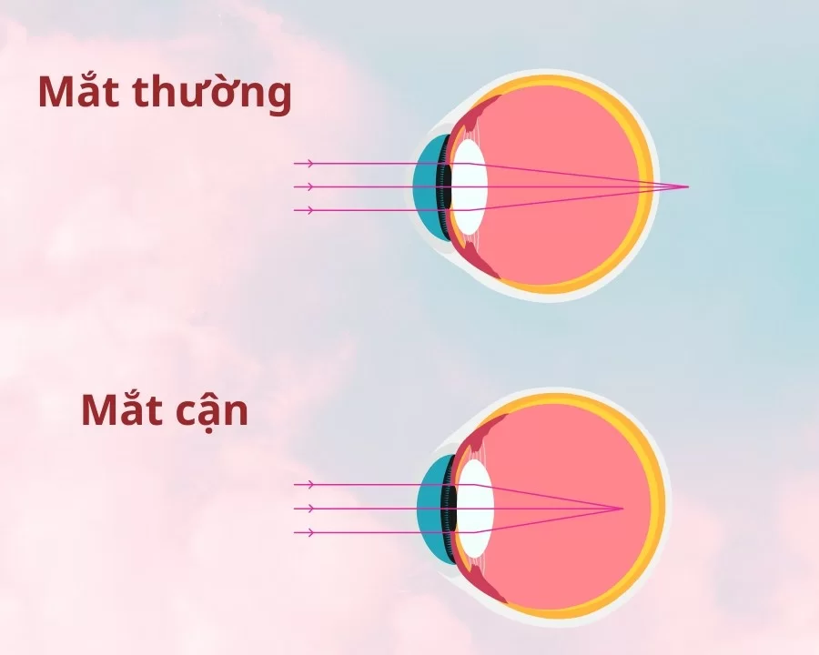 Chiều dài trục nhãn cầu: Thông số quan trọng trong kiểm soát cận thị ở trẻ em (4) Trục nhãn cầu là gì