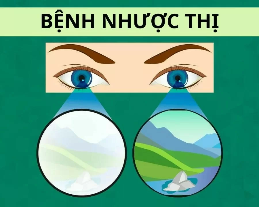 Cận 2 độ có nên đeo kính thường xuyên? 3 sự thật cần biết (3) Thị lực 1 mắt bị giảm khi mắt nhược thị
