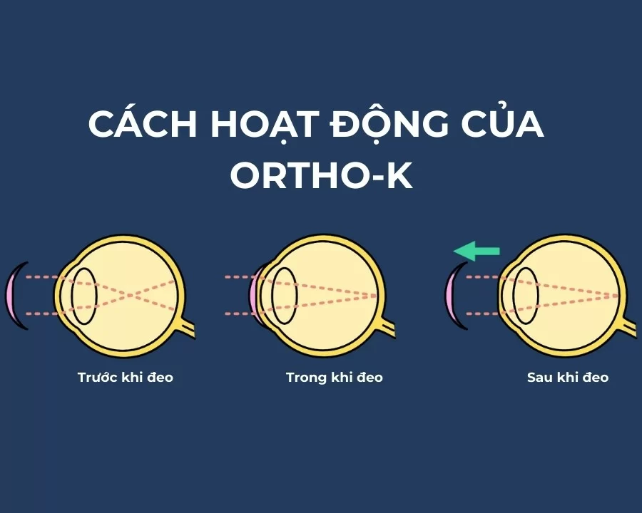 10 cách chữa cận thị hiệu quả nhất 2025, ưu và nhược điểm (5) Cách hoạt động của Ortho-K