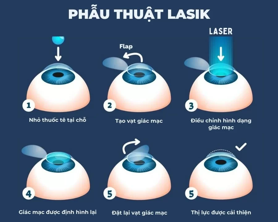 10 cách chữa cận thị hiệu quả nhất 2025, ưu và nhược điểm (7) Cơ chế hoạt động của phẫu thuật Lasik