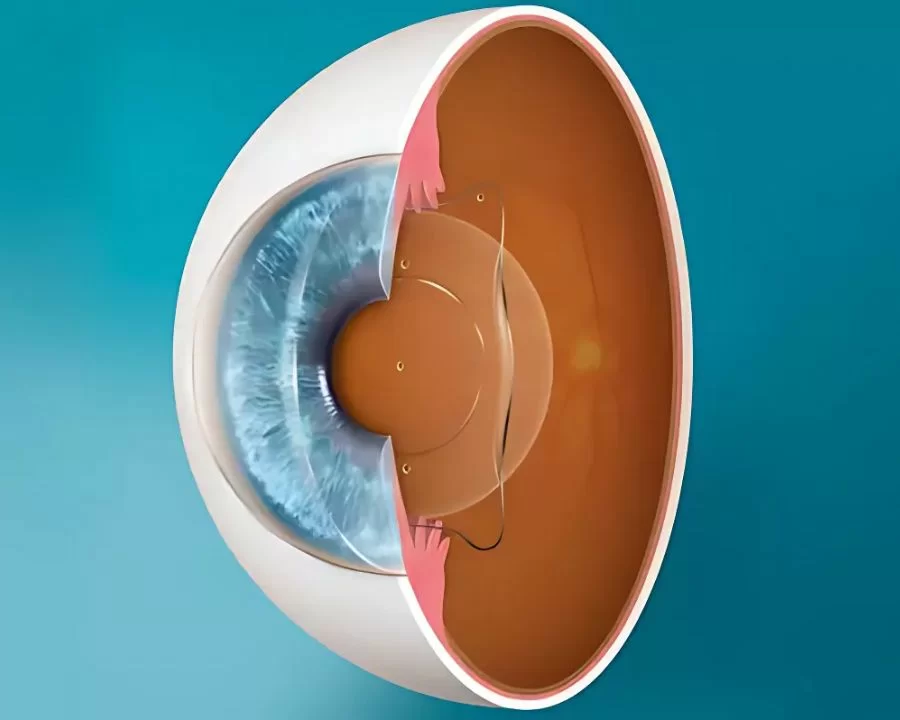 Bắn mắt cận: Điều kiện, chi phí, 3 lời khuyên vàng từ bác sĩ (7) Phakic ICL/IPCL là cách xóa cận không dùng laser, mà đặt thêm một thấu kính nội nhãn vào mắt. Không mài giác mạc, giữ nguyên cấu trúc mắt và không gây khô mắt.
