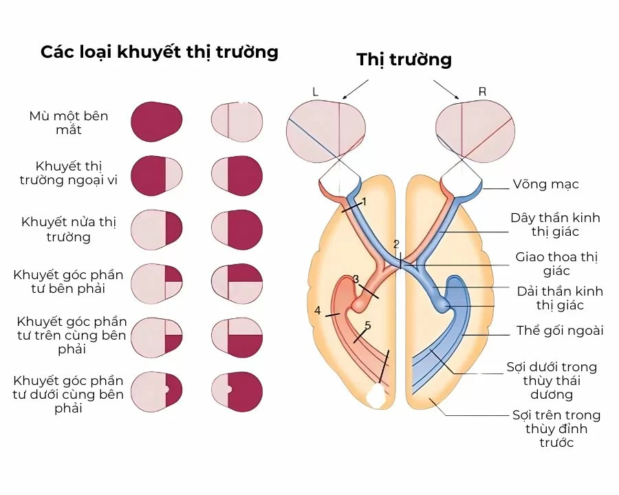 Khuyết thị trường là gì? Chuyên gia nói về 3 điều cần chú ý (2) Các bộ phận thị giác và các loại khuyết thị trường thường gặp.