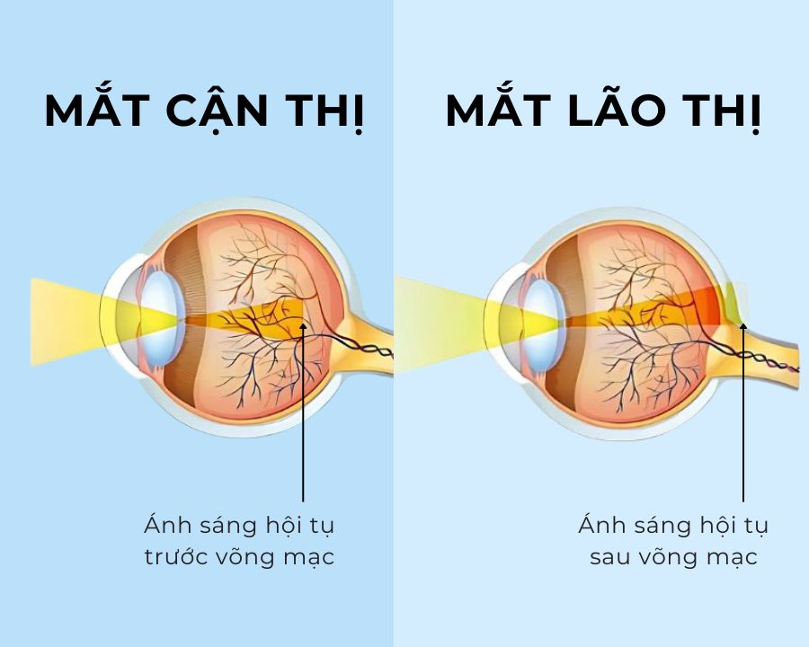 Phân biệt cận thị và lão thị: Có thể bị cùng lúc không? (7) Cận thị và lão thị khác nhau như thế nào