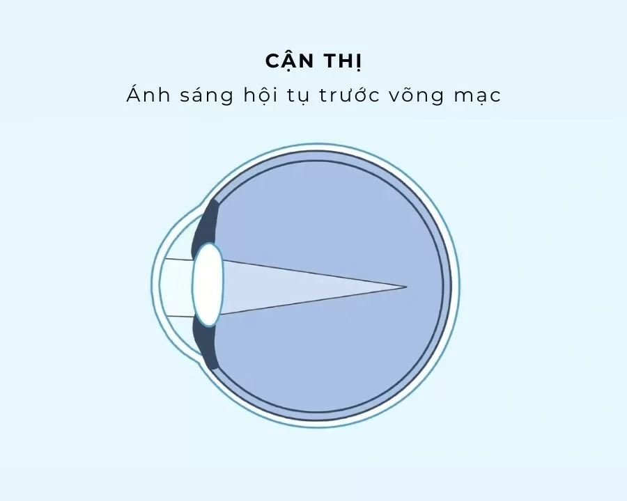 Phân biệt cận thị và viễn thị: Triệu chứng và cách chữa trị (2) Cận thị xảy ra do nhãn cầu dài hoặc giác mạc cong quá mức, khiến hình ảnh hội tụ trước võng mạc