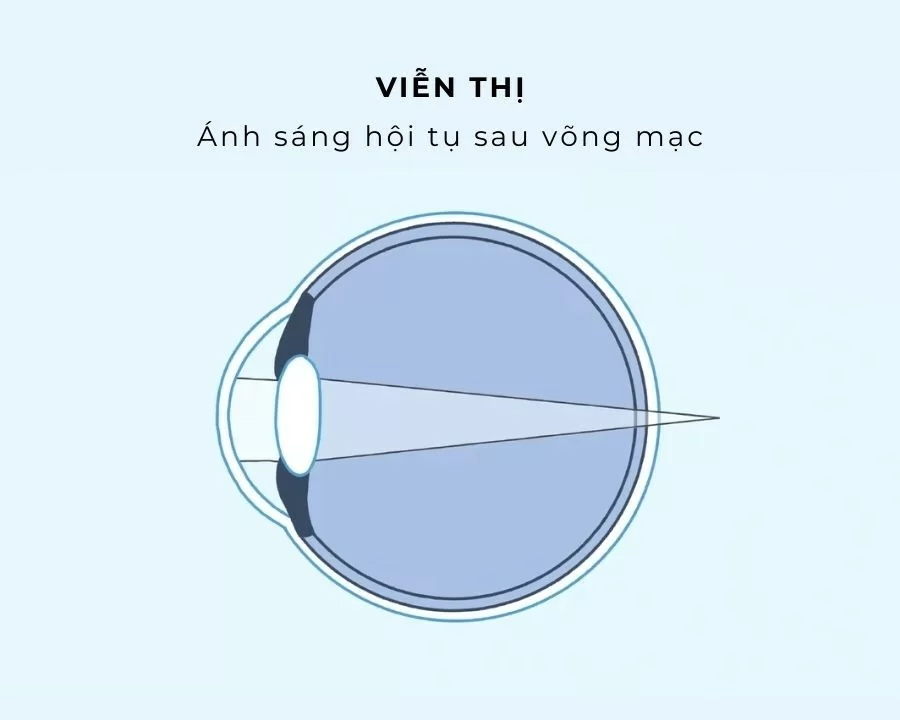 Phân biệt cận thị và viễn thị: Triệu chứng và cách chữa trị (3) Viễn thị xảy ra do nhãn cầu ngắn hoặc giác mạc quá dẹt, khiến hình ảnh hội tụ sau võng mạc