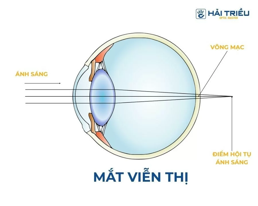 Viễn thị là gì? 3 phút hiểu ngay nguyên nhân, cách điều trị (2) Giải thích về cơ chế hoạt động của mắt bị viễn thị