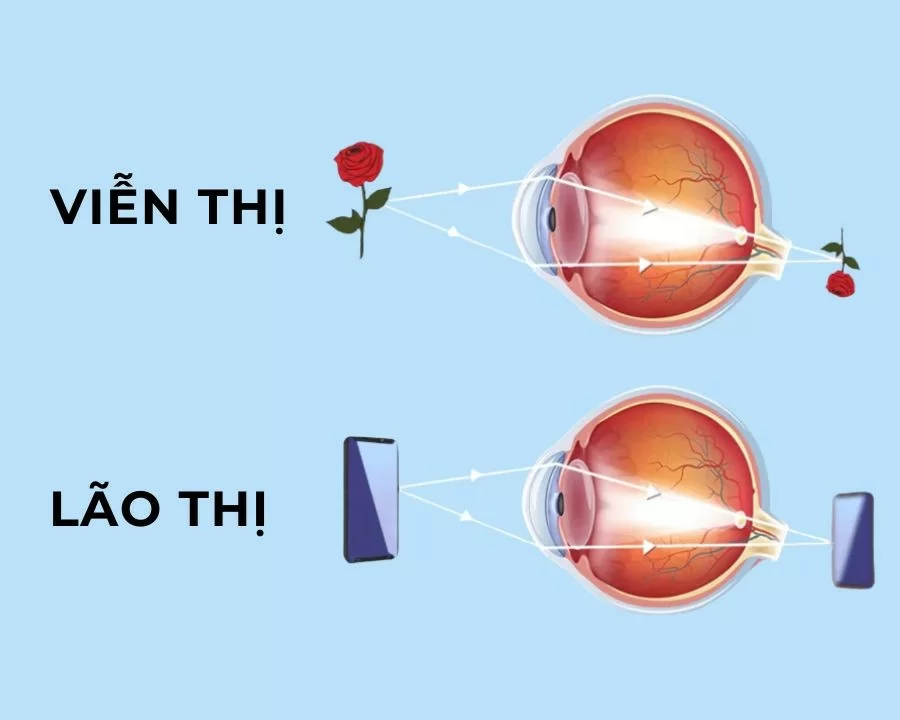 Viễn thị và lão thị khác nhau thế nào? Nguyên nhân, điều trị (3) vien thi va lao thi khac nhau nhu the nao nguyen nhan dieu tri bia 1