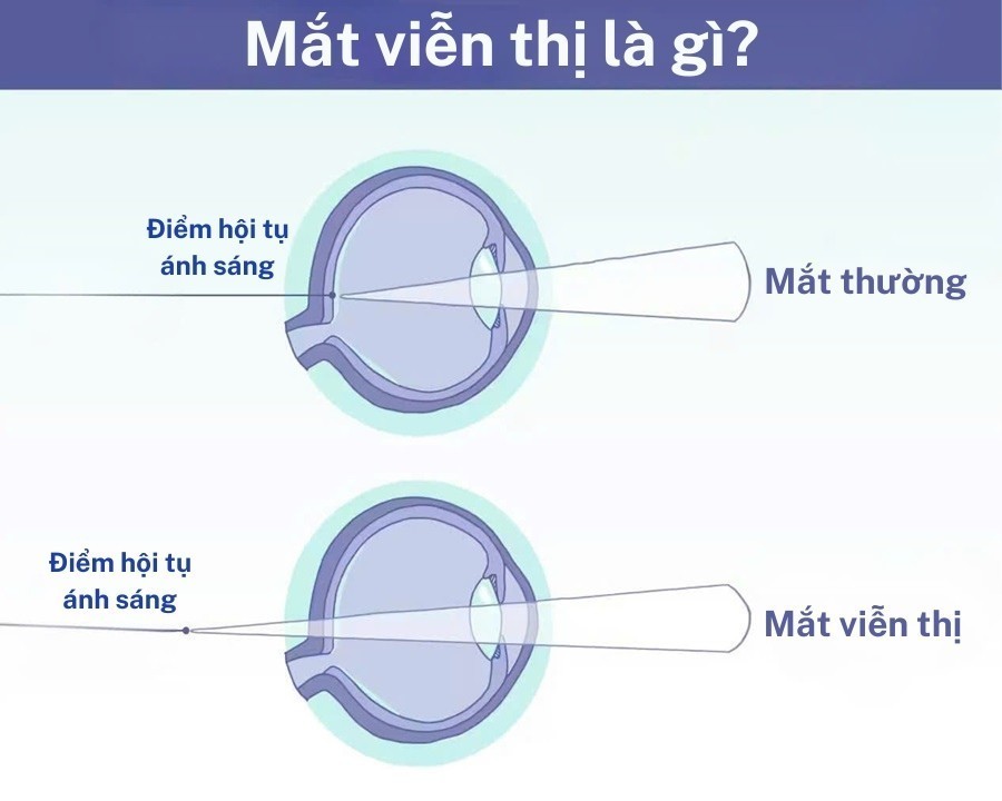 Viễn thị ở trẻ em là gì? Nguyên nhân, dấu hiệu và điều trị từ A tới Z (2) Điểm hội tụ ánh sáng nằm xa võng mạc là nguyên nhân gây ra viễn thị ở trẻ em