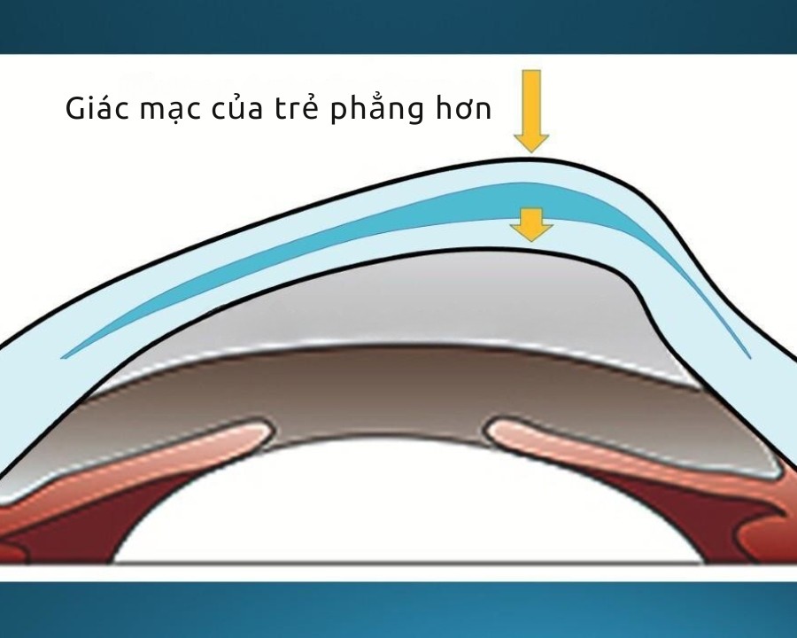 Viễn thị ở trẻ em là gì? Nguyên nhân, dấu hiệu và điều trị từ A tới Z (3) Ở viễn thị khúc xạ, giác mạc của trẻ phẳng hơn bình thường