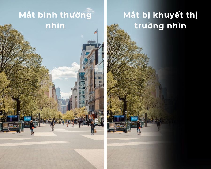 Phân biệt sự khác nhau giữa mắt bình thường và mắt bị khuyết thị trường.