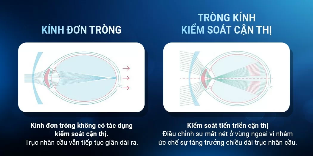 So sánh tròng kính thường và tròng kính kiểm soát cận thị