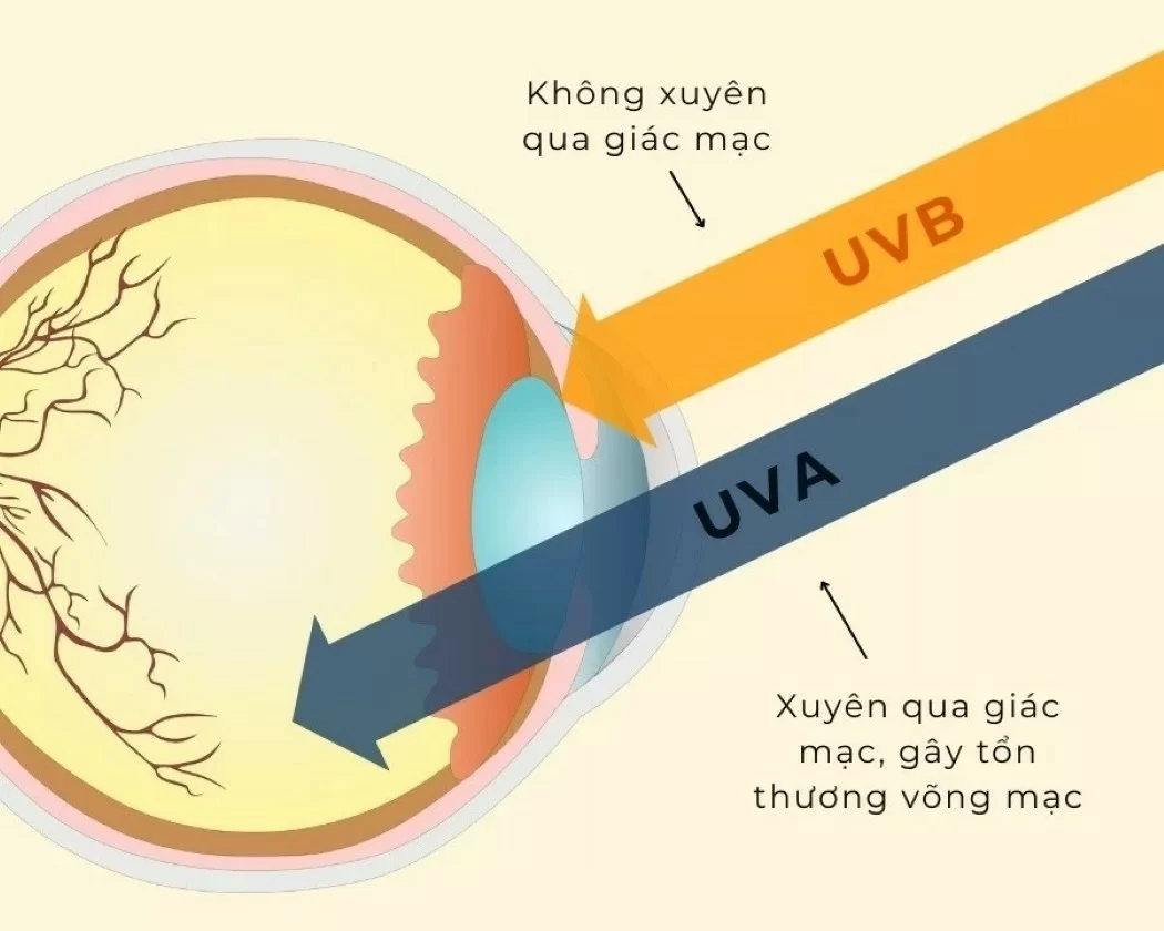 Tia UVA xuyên qua giác mạc gây tổn thương võng mạc