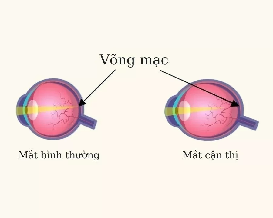 Giảm cận thị 3-4 độ tại nhà có được không? 9 cách kiểm soát không cần phẫu thuật (2) Giảm cận thị 3 4 độ tại nhà có được không? Sự thật cần biết