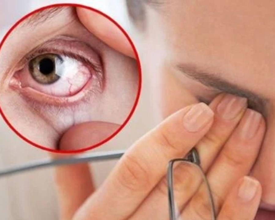 Cận cảnh mắt bị đỏ, kích ứng và mỏi mệt do ảnh hưởng của màn hình thiết bị điện tử